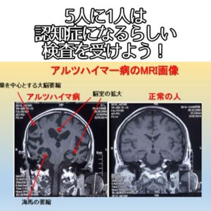 5人に1人は認知症になるらしいから、検査を受けよう！