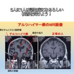 5人に1人は認知症になるらしいから、検査を受けよう！